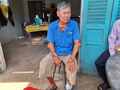 Căn bệnh gút mang lại nỗi đau bệnh tật cho người đàn ông khốn khó