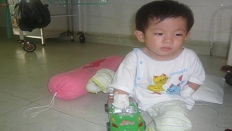Bé 20 tháng tuổi bị cưa cụt hết tay, chân để sống 