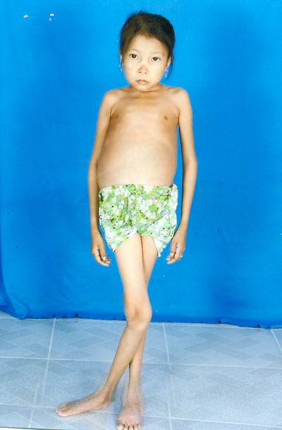 Xin cứu cháu Tuyết 