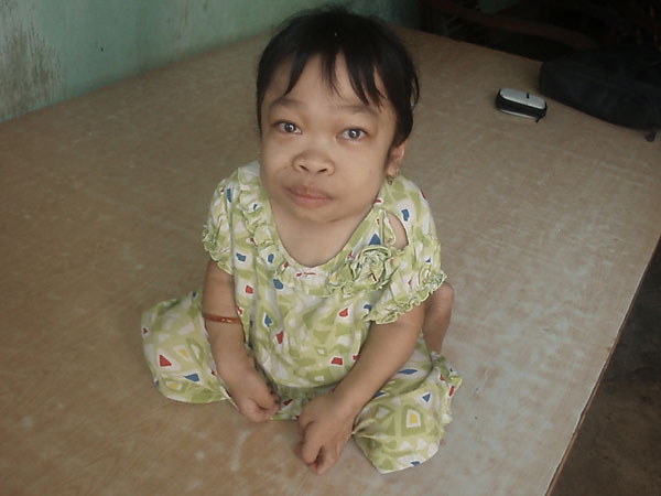 Cần lắm một chiếc xe lăn cho em Dung 